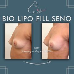 Bio lipo fill seno Dott. Luca Lungo Vaschetto