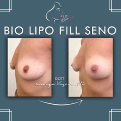 Bio lipo fill seno Dott. Luca Lungo Vaschetto