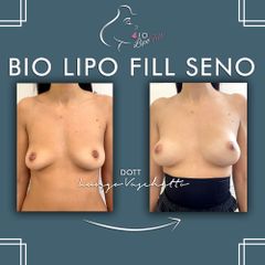 Bio lipo fill seno Dott. Luca Lungo Vaschetto