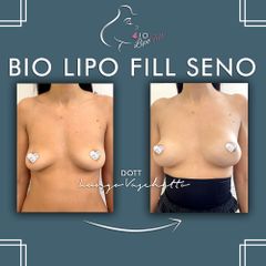 Bio lipo fill seno Dott. Luca Lungo Vaschetto