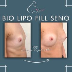 Bio lipo fill seno Dott. Luca Lungo Vaschetto