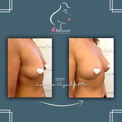 Bio lipo fill seno Dott. Luca Lungo Vaschetto