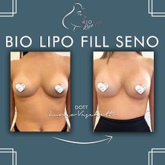 Lipofilling - Dott. Luca Lungo Vaschetto