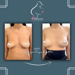Lipofilling - Dott. Luca Lungo Vaschetto