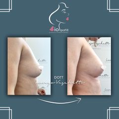 Lipofilling - Dott. Luca Lungo Vaschetto