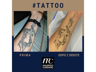 Rimozione tatuaggi - Dott.Maurizio Cursano