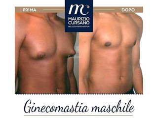 Ginecomastia - Dott.Maurizio Cursano