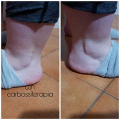 carbossiterapia prima dopo