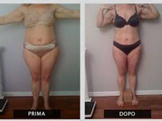 Liposcultura prima e dopo