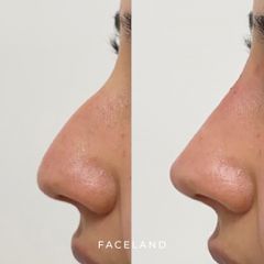 Faceland Rinofiller