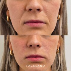 Faceland Filler Nasolabiali