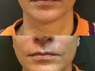 Rughe prima e dopo - 876833