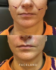 Faceland rughe nasolabiali