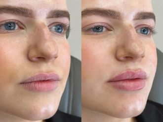 Filler labbra prima e dopo - 876834