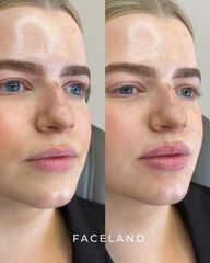 Faceland filler labbra