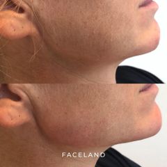 Faceland filler mandibolare