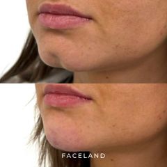 Faceland ritocco mento con acido ialuronico