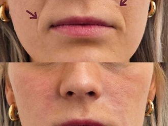 Rughe prima e dopo - 876837