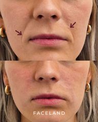 Faceland rughe nasolabiali