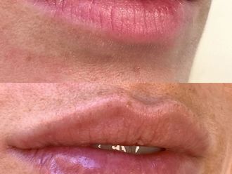 Filler labbra prima e dopo - 876838