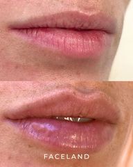Faceland Filler Labbra