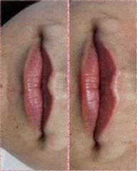 filler labbra - Dott.ssa Demurtas Elena