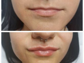 Filler labbra prima e dopo - 876842