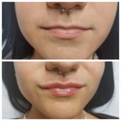 Dott.ssa Demurtas Elena Filler labbra