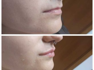 Filler labbra prima e dopo - 876843