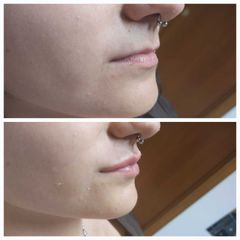 Dott.ssa Demurtas Elena Filler labbra