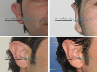 Otoplastica prima e dopo