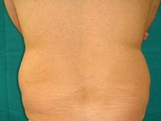Liposuzione fianchi pre-operatorio