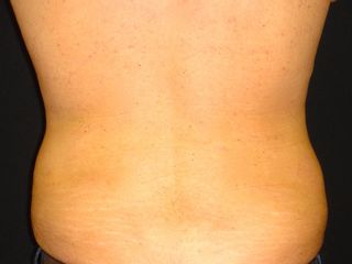 LIposuzione fianchi post-operatorio