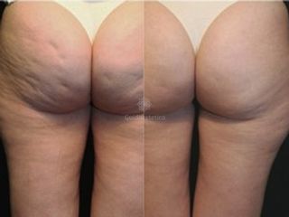 Cavitazione prima e dopo