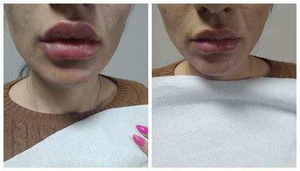 Filler labbra - Centro Medicina Estetica Dott.ssa Cirò