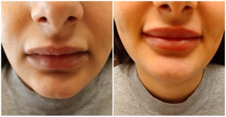 Filler labbra  - Centro Medicina Estetica Dott.ssa Cirò