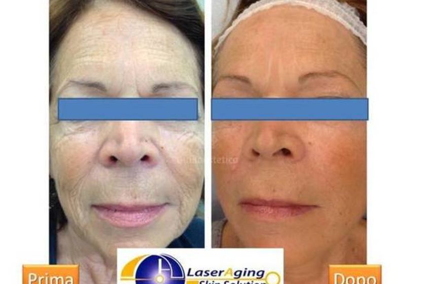 Laserterapia prima e dopo - 763157