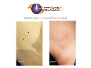 rimozione fibropapillomi prima dopo