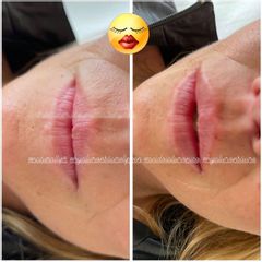 Filler labbra - Dott. Lorenz Larcher