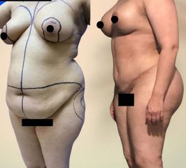 Mommy Makeover - Clinica DaVINCI