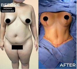 Mommy Makeover - Clinica DaVINCI