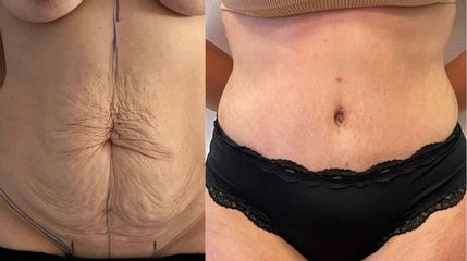 Addominoplastica - Clinica DaVINCI