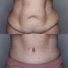 Addomionoplastica - Clinica DaVINCI