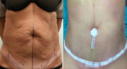 Addominoplastica - Clinica DaVINCI