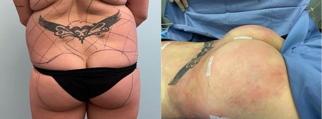 Gluteoplastica - Clinica DaVINCI