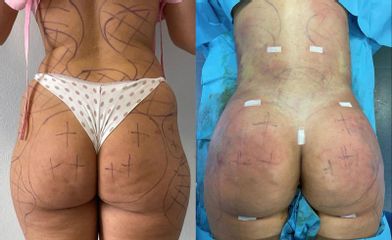 Gluteoplastica - Clinica DaVINCI