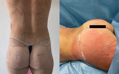 Gluteoplastica - Clinica DaVINCI