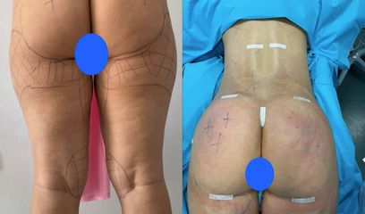 Gluteoplastica - Clinica DaVINCI
