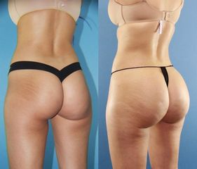 Gluteoplastica - Clinica DaVINCI