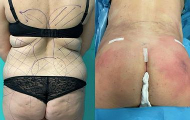Gluteoplastica - Clinica DaVINCI